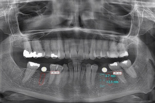 OPG Dental X-ray